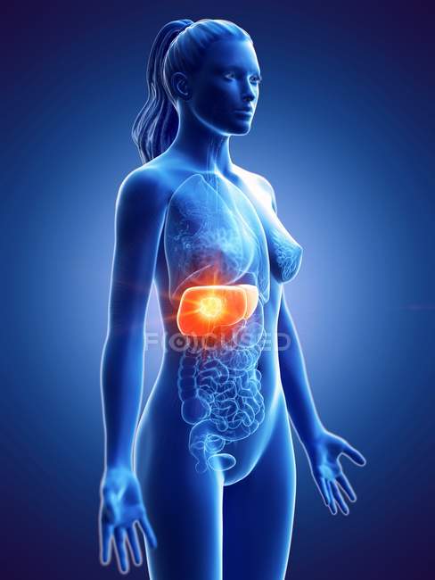 Weibliche Silhouette mit Tumor in der Leber auf blauem Hintergrund, Computerillustration. — Stockfoto