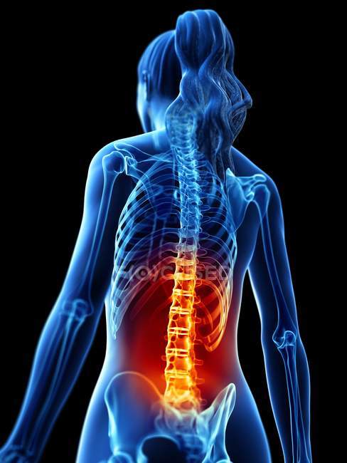 Silhouette des weiblichen Körpers mit Rückenschmerzen, konzeptionelle digitale Illustration. — Stockfoto