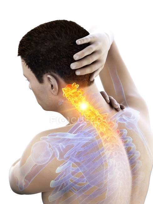 Cuerpo masculino con dolor de cuello visible, ilustración conceptual
. - foto de stock