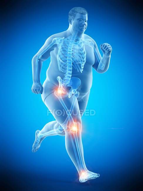 Silhouette of running obese man with joint pain, computer illustration. — Stock Photo