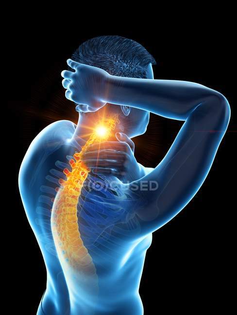Cuerpo masculino con dolor de cuello visible, ilustración conceptual . - foto de stock