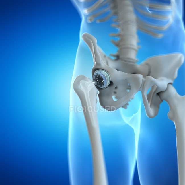 Orthopedics hip replacement on blue background, digital illustration. — Stock Photo