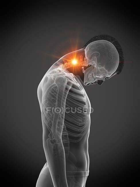 Абстрактний людський силует з пошкодженою шиєю з болем, концептуальна ілюстрація . — стокове фото