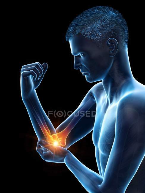 Male body with visible elbow pain, conceptual illustration. — Stock Photo