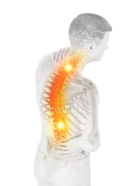 Männliche Silhouette mit Rückenschmerzen im Hochwinkel, konzeptionelle Illustration. — Stockfoto