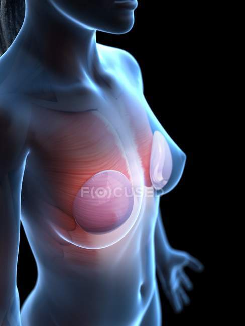 Анатомія молочних імплантатів в жіночому тілі 3d модель, цифрове зображення. — стокове фото