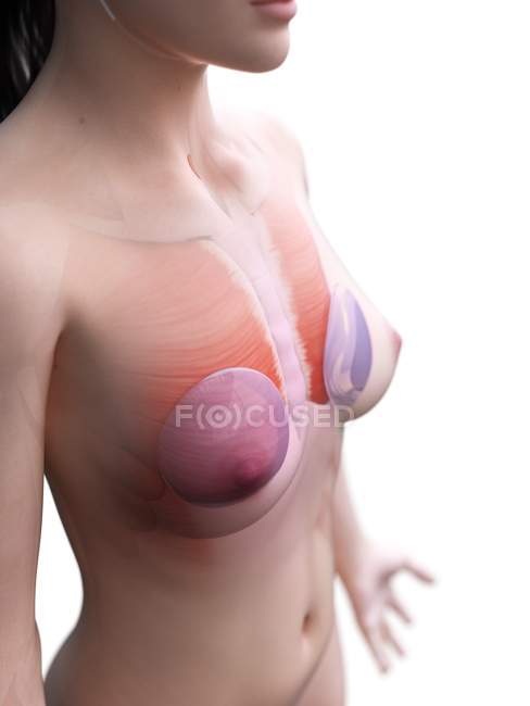 Anatomía de los implantes mamarios en el modelo 3d del cuerpo femenino, ilustración digital . - foto de stock