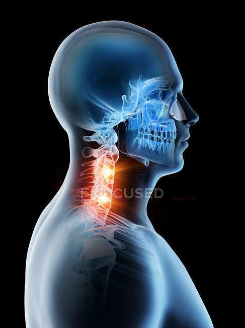 Abstrakter männlicher Körper mit detaillierten Nackenschmerzen, konzeptionelle digitale Illustration. — Stockfoto