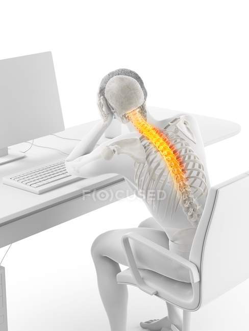 Trabajador de oficina estresado con dolor de espalda, ilustración conceptual . - foto de stock