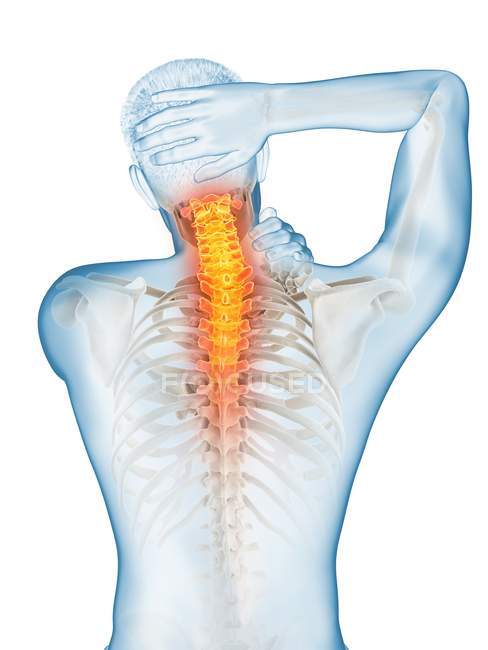 Corpo masculino em visão traseira com dor visível no pescoço, ilustração conceitual . — Fotografia de Stock