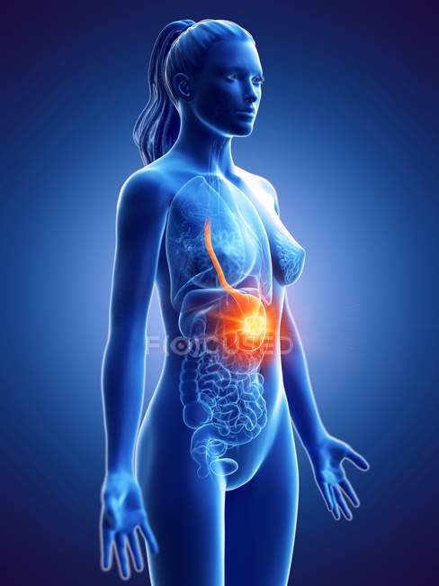Magenkrebs im weiblichen Körper, konzeptionelle Computerillustration. — Stockfoto