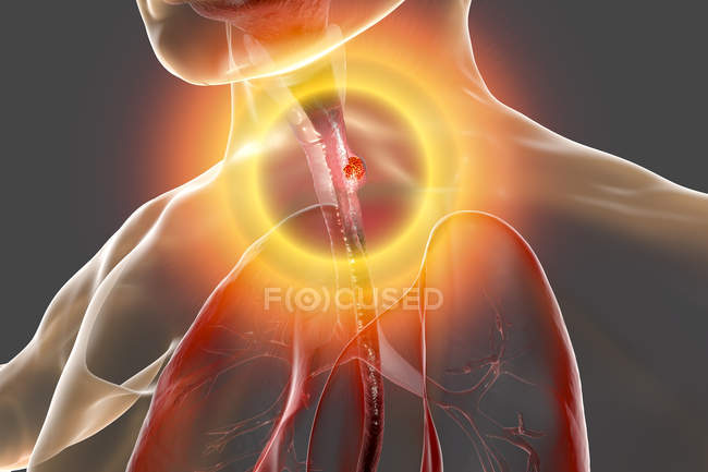 Speiseröhrenkrebs im männlichen Körper, abstrakte digitale Illustration. — Stockfoto