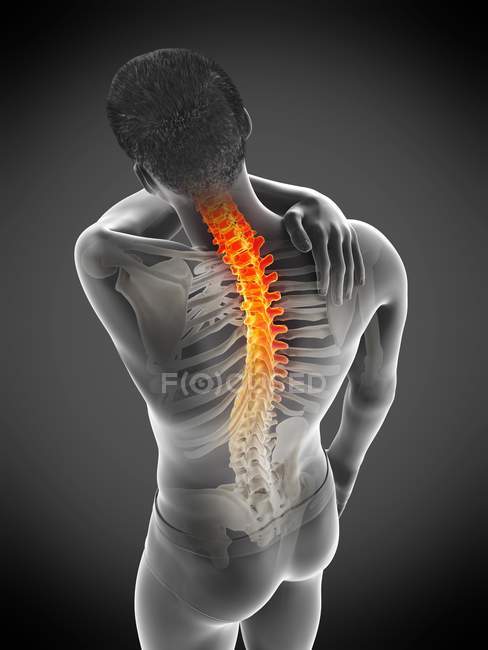 Silueta masculina con la mano en la inflamación del dolor de espalda, ilustración conceptual . - foto de stock