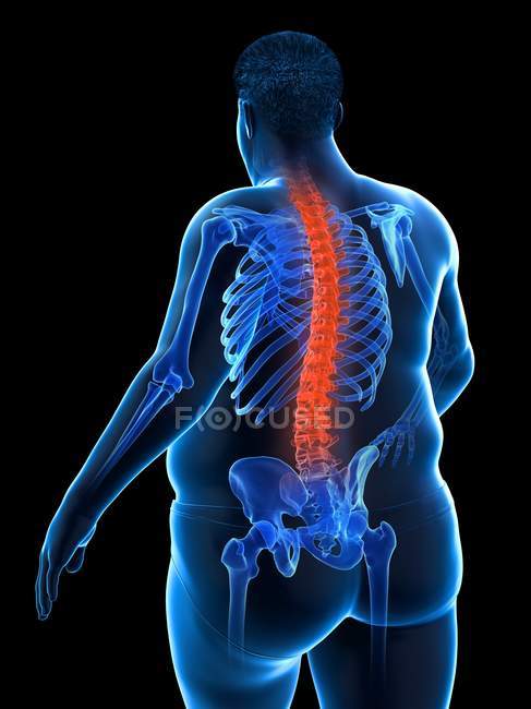 Übergewichtiger männlicher Körper mit Rückenschmerzen, digitale Illustration. — Stockfoto