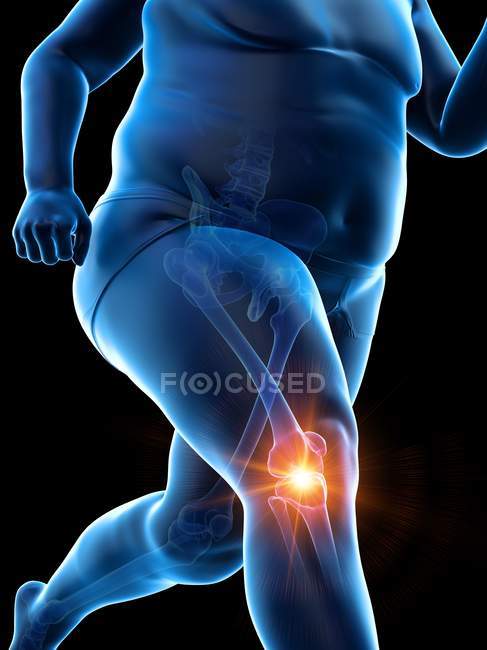 Силуэт мужского толстого бегуна с болью в колене, концептуальная цифровая иллюстрация . — стоковое фото