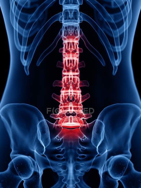 Menschliche Silhouette mit Rückenschmerzen, konzeptionelle Illustration. — Stockfoto
