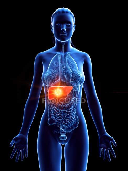 Female silhouette with tumor in liver on black background, computer illustration. — Stock Photo