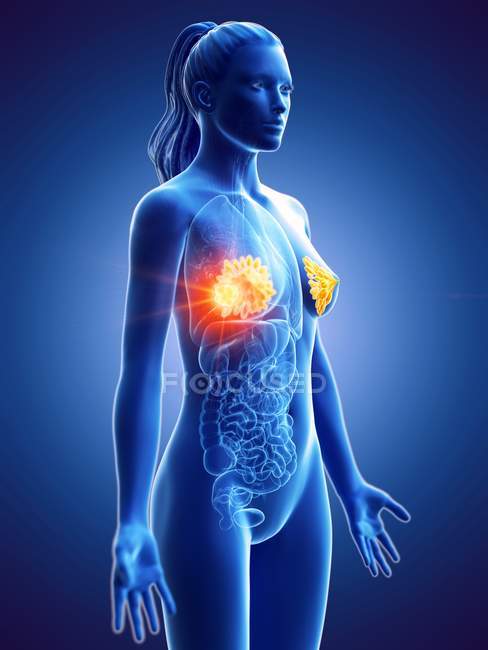 Жіночий силует з раком молочної залози, Концептуальна Цифрова ілюстрація. — стокове фото