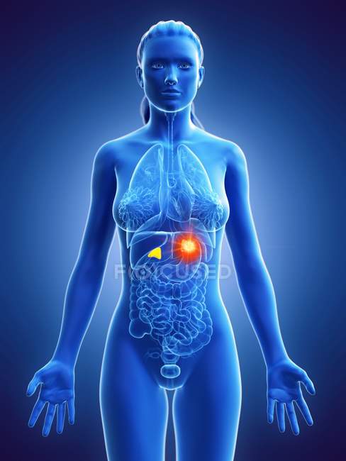 Cuerpo femenino con cáncer de glándulas suprarrenales, ilustración por computadora
. - foto de stock