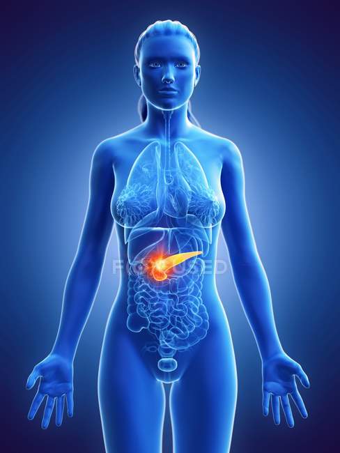 Рак поджелудочной железы в женском теле, концептуальная компьютерная иллюстрация . — стоковое фото