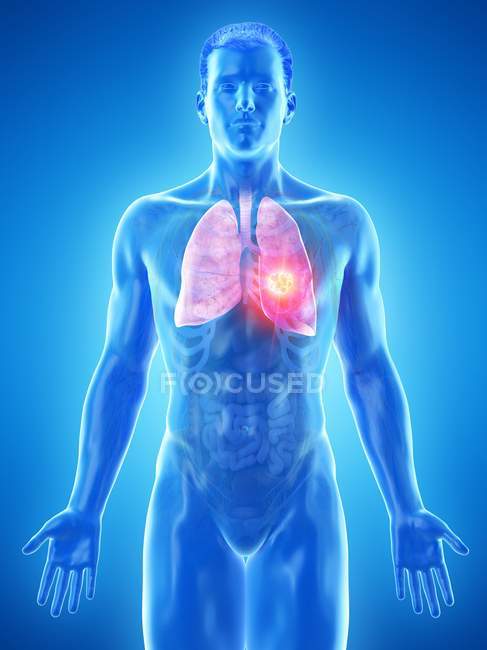 Cáncer de pulmón en la anatomía del cuerpo masculino, ilustración por computadora
. - foto de stock