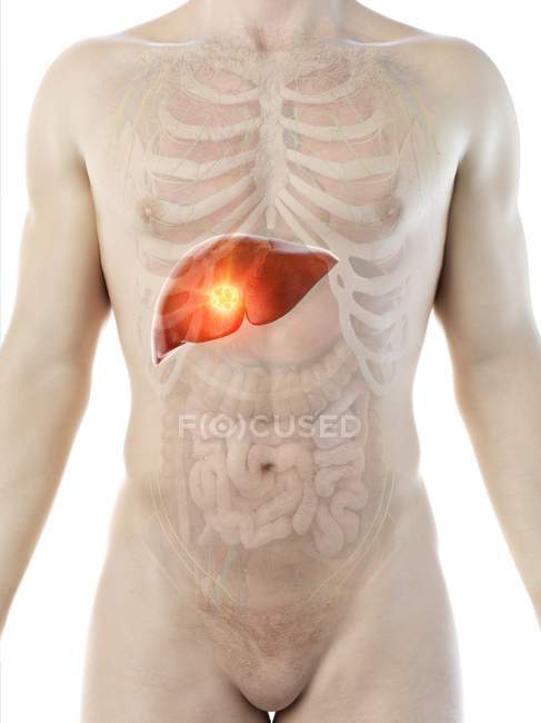 Cáncer de hígado en silueta corporal masculina, ilustración digital
. - foto de stock