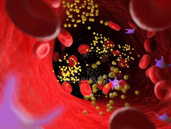 Graisse dans les cellules sanguines bloquant les vaisseaux sanguins, illustration numérique
. — Photo de stock