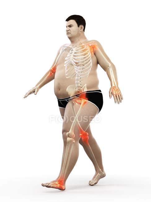 Silhouette eines fettleibigen Mannes mit Gelenkschmerzen, Computerillustration. — Stockfoto