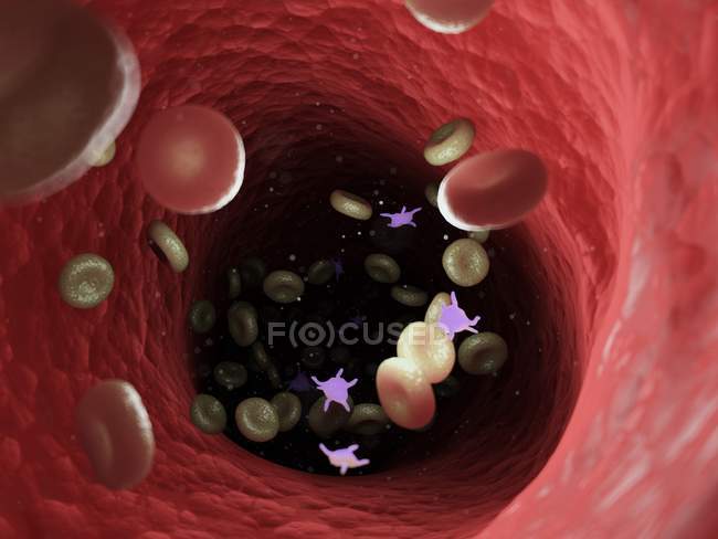 Kranke Blutzellen mit Bakterien, Computerillustration. — Stockfoto