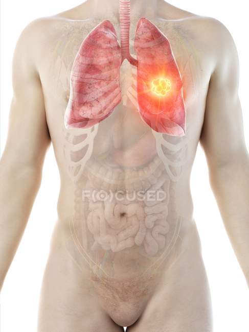 Cáncer de pulmón en la anatomía del cuerpo masculino, ilustración por computadora
. - foto de stock