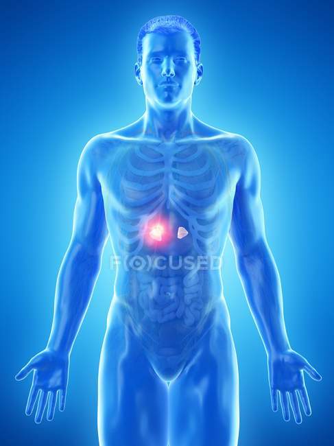 Tumor de la glándula suprarrenal en el cuerpo masculino, ilustración conceptual por ordenador
. - foto de stock