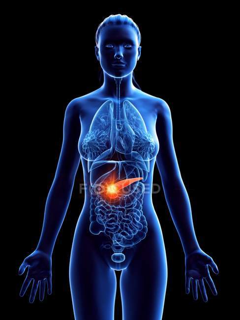 Cancro al pancreas nel corpo femminile, illustrazione concettuale del computer . — Foto stock