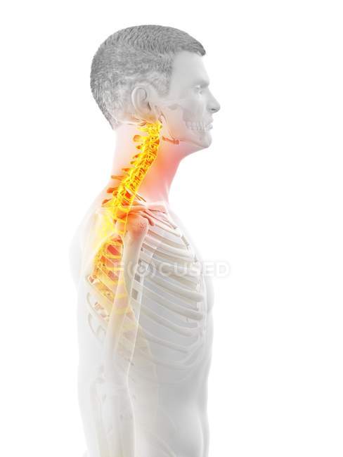 Silhueta masculina com dor no pescoço, ilustração conceitual . — Fotografia de Stock
