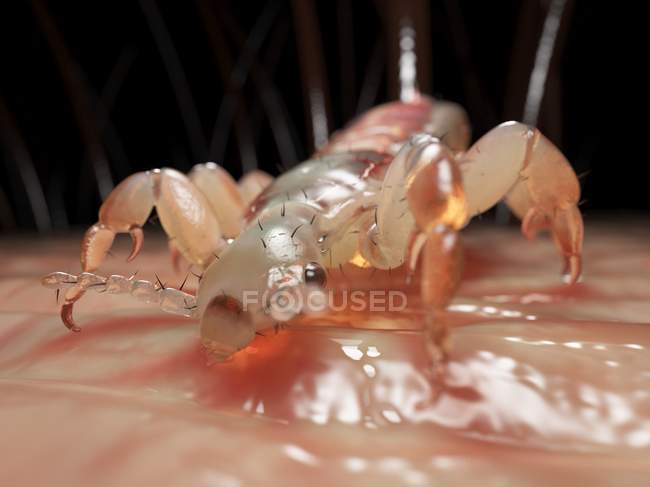 Pidocchio parassitario sulla pelle della testa umana, illustrazione digitale . — Foto stock