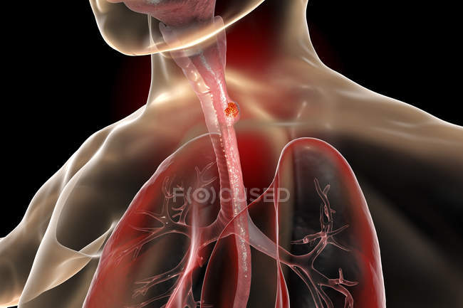 Esophageal cancer in male body, abstract digital illustration. — Stock Photo