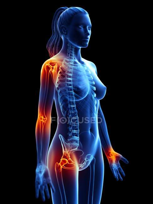 Female silhouette with places of joint pain, conceptual computer illustration. — Stock Photo