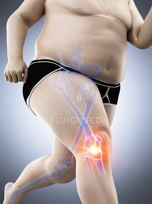 Silhouette de coureur obèse mâle ayant des douleurs au genou, illustration numérique conceptuelle . — Photo de stock