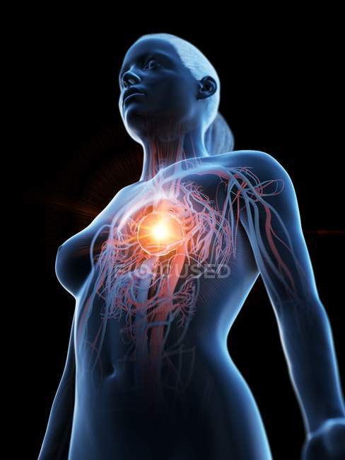 Ataque cardíaco no corpo humano, ilustração conceitual . — Fotografia de Stock