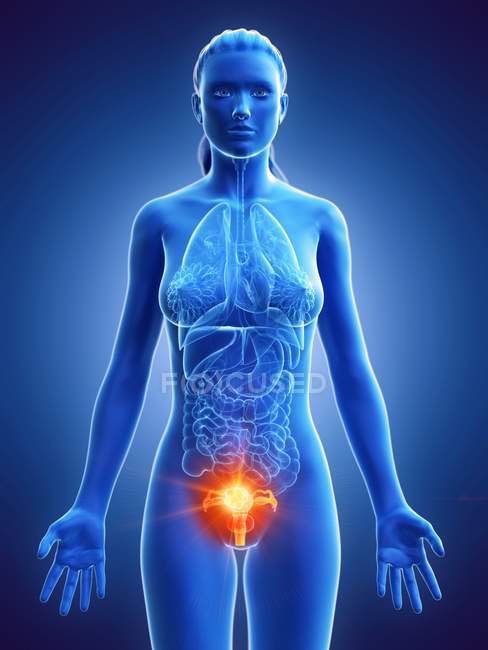 Рак матки в жіночому тілі, концептуальний комп'ютерний малюнок.. — стокове фото