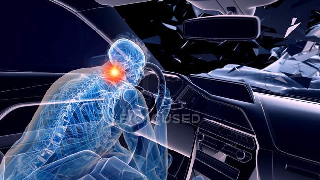 X-ray illustration of risk of neck injury while head-on car crash, digital artwork. — Stock Photo