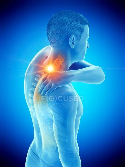 Silhueta do homem com dor no pescoço, ilustração conceitual . — Fotografia de Stock
