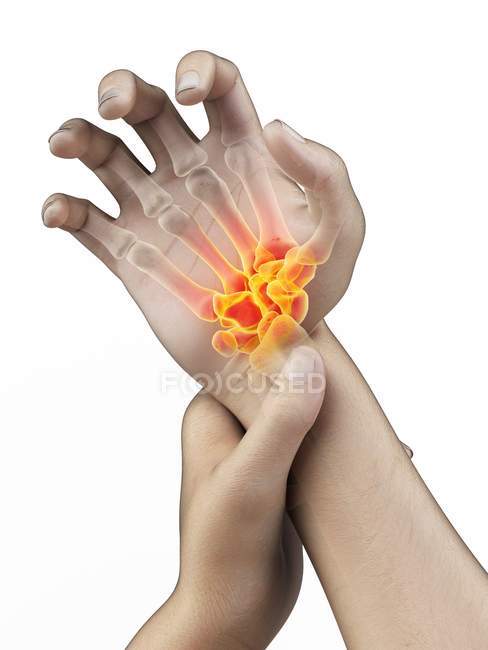 Mãos masculinas com dor de pulso brilhante, ilustração conceitual
. — Fotografia de Stock