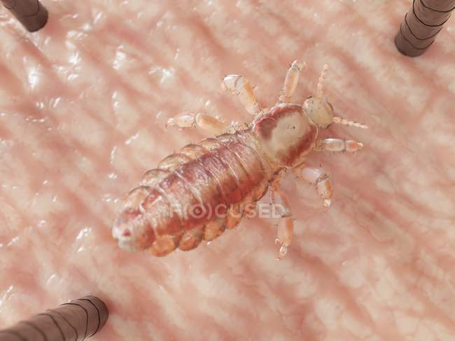 Parasitic louse on human head skin, digital illustration. — Stock Photo