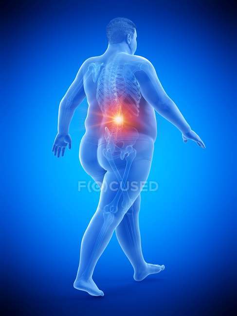 Walking obese male silhouette with visible back pain, digital illustration. — Stock Photo