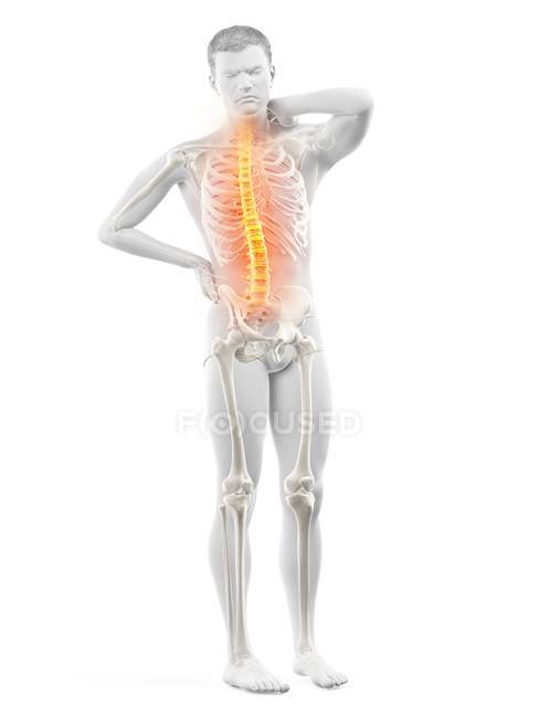 Чоловіче тіло з болем у спині на білому тлі, концептуальна ілюстрація . — стокове фото