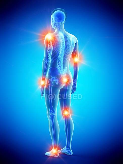 Cuerpo humano con puntos de dolor articular, ilustración conceptual
. - foto de stock