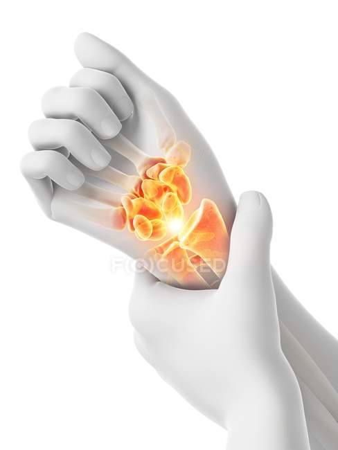 Abstract human hands with wrist pain, conceptual illustration. — Stock Photo