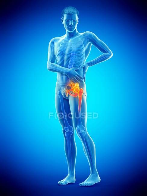 Silhouette eines Mannes mit Hüftschmerzen, digitale Illustration. — Stockfoto