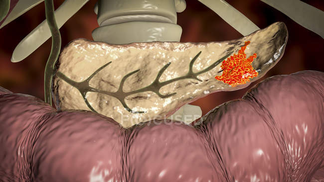Digital illustration showing malignant growth  in pancreas while pancreatic cancer. — Stock Photo