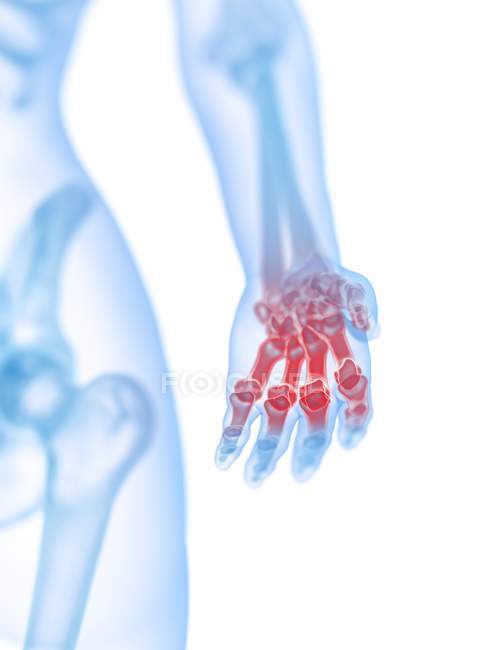 Human silhouetted hand in pain, conceptual illustration. — Stock Photo